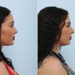 Non-Surgical Rhinoplasty before and after photos in Houston, TX, Patient 43115