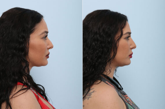 Non-Surgical Rhinoplasty before and after photos in Houston, TX, Patient 43115