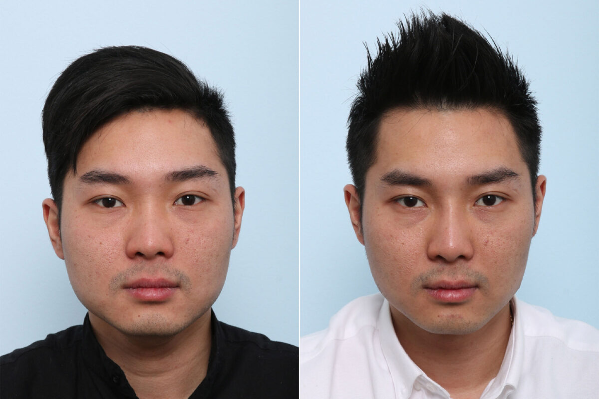 Patient 43122, Non-Surgical Rhinoplasty before and after photos Non-Surgical Rhinoplasty before and after photos in Houston, TX, Patient 43122