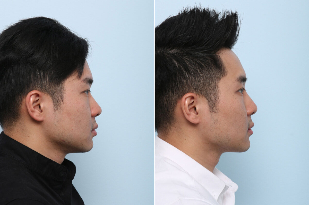 Non-Surgical Rhinoplasty before and after photos in Houston, TX, Patient 43122