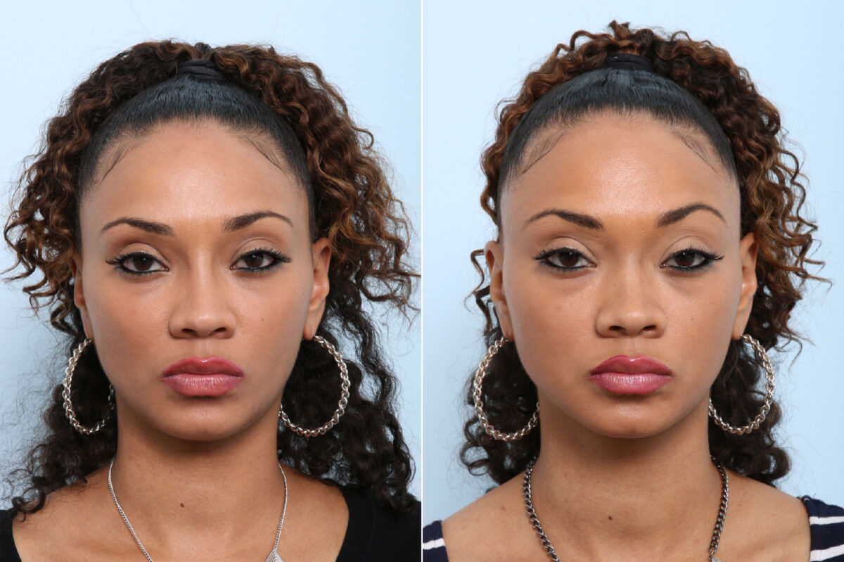 Patient 43129, Non-Surgical Rhinoplasty before and after photos Non-Surgical Rhinoplasty before and after photos in Houston, TX, Patient 43129