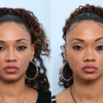 Non-Surgical Rhinoplasty before and after photos in Houston, TX, Patient 43129