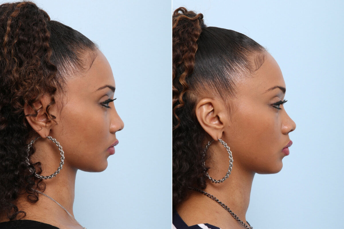 Non-Surgical Rhinoplasty before and after photos in Houston, TX, Patient 43129