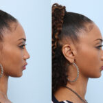 Non-Surgical Rhinoplasty before and after photos in Houston, TX, Patient 43129