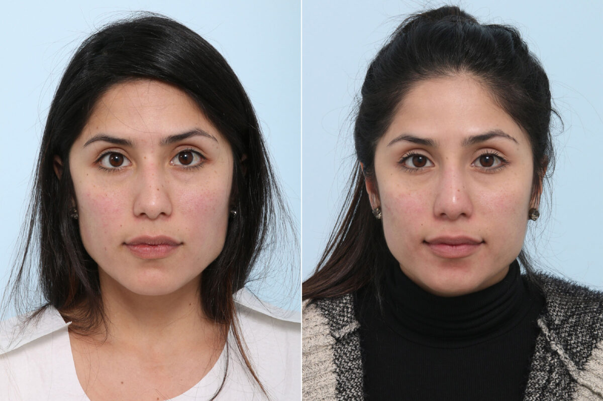 Patient 43136, Non-Surgical Rhinoplasty before and after photos Non-Surgical Rhinoplasty before and after photos in Houston, TX, Patient 43136