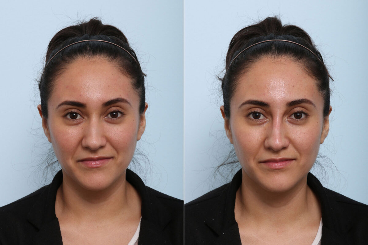 Patient 43143, Non-Surgical Rhinoplasty before and after photos Non-Surgical Rhinoplasty before and after photos in Houston, TX, Patient 43143