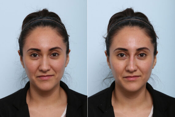 Non-Surgical Rhinoplasty before and after photos in Houston, TX, Patient 43143