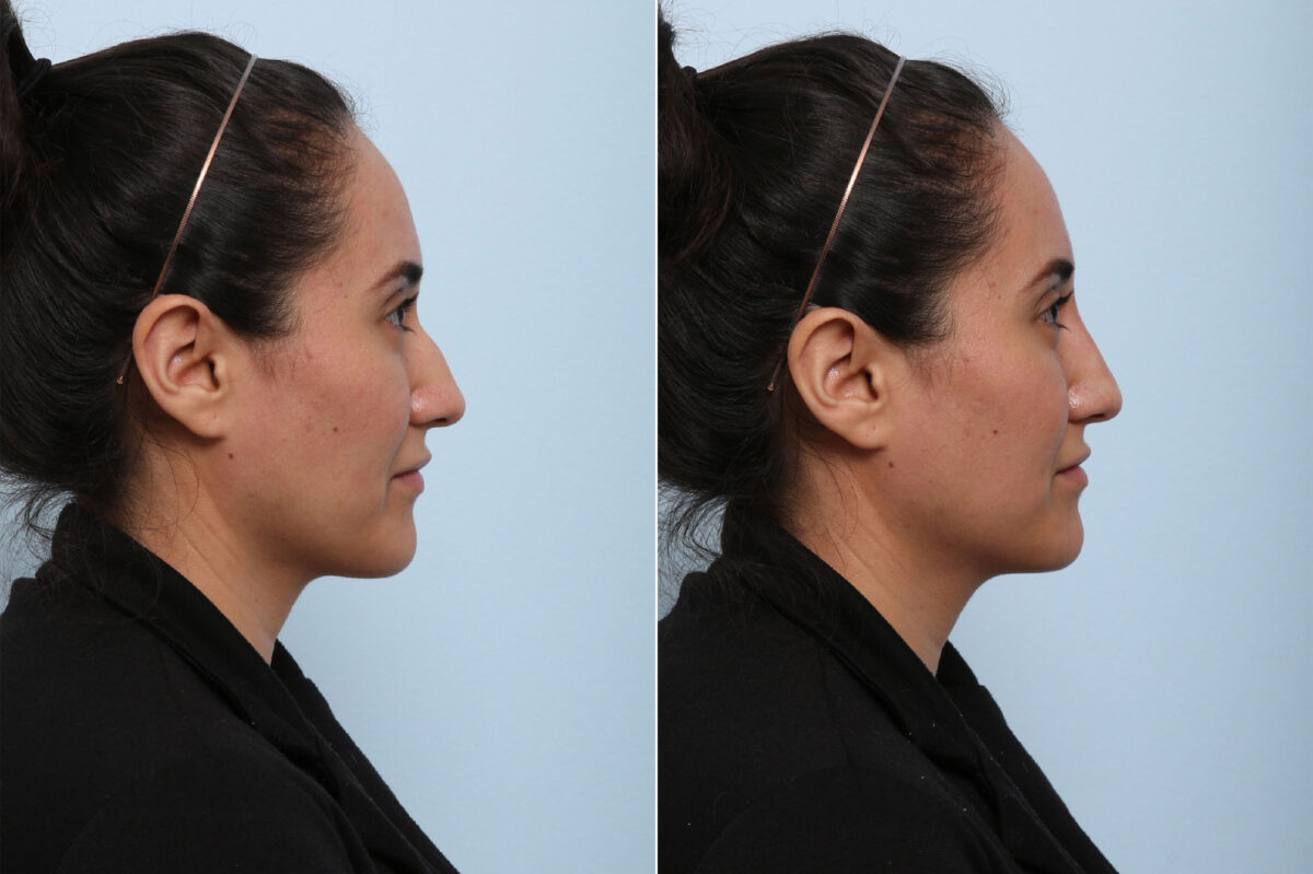 Non-Surgical Rhinoplasty before and after photos in Houston, TX, Patient 43143