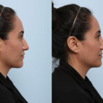 Non-Surgical Rhinoplasty before and after photos in Houston, TX, Patient 43143