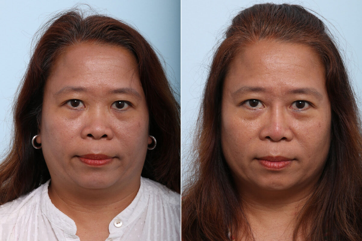 Patient 43150, Non-Surgical Rhinoplasty before and after photos Non-Surgical Rhinoplasty before and after photos in Houston, TX, Patient 43150