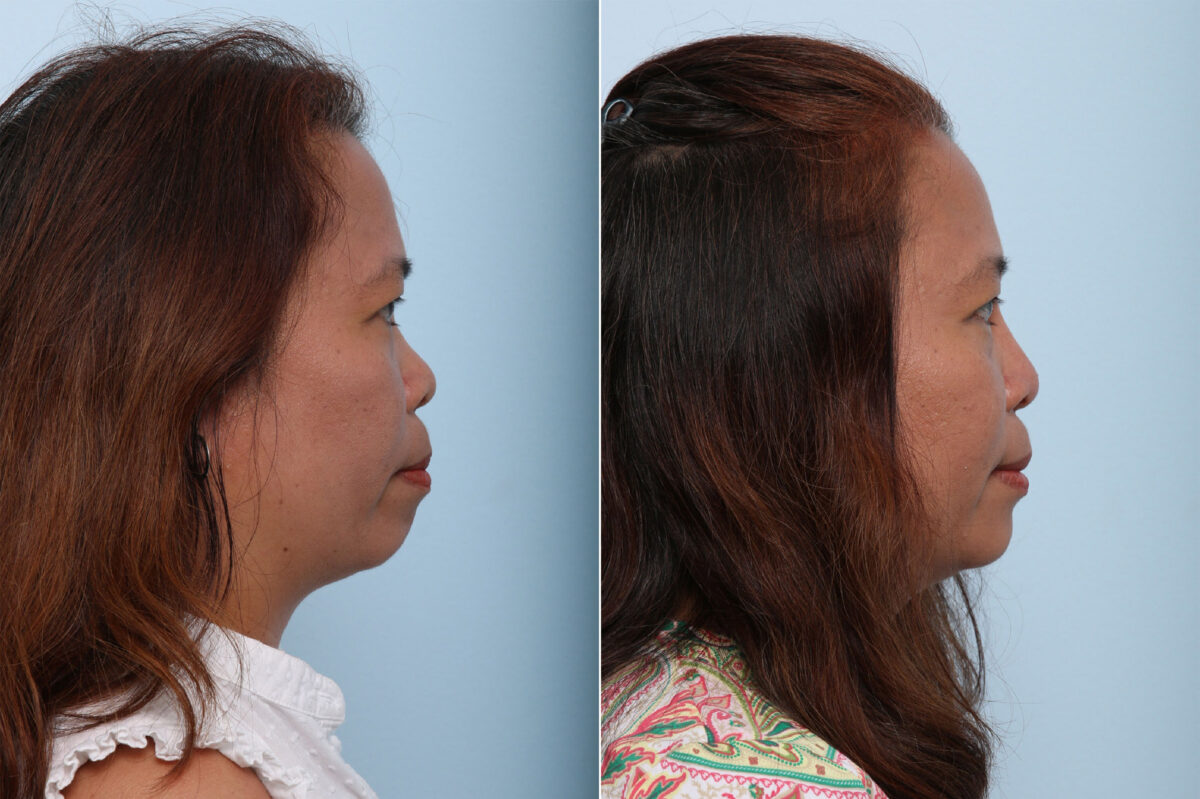 Non-Surgical Rhinoplasty before and after photos in Houston, TX, Patient 43150