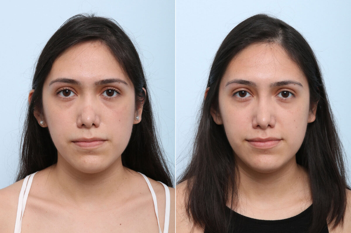 Non-Surgical Rhinoplasty before and after photos in Houston, TX, Patient 43157