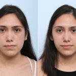 Non-Surgical Rhinoplasty before and after photos in Houston, TX, Patient 43157