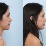 Non-Surgical Rhinoplasty before and after photos in Houston, TX, Patient 43157