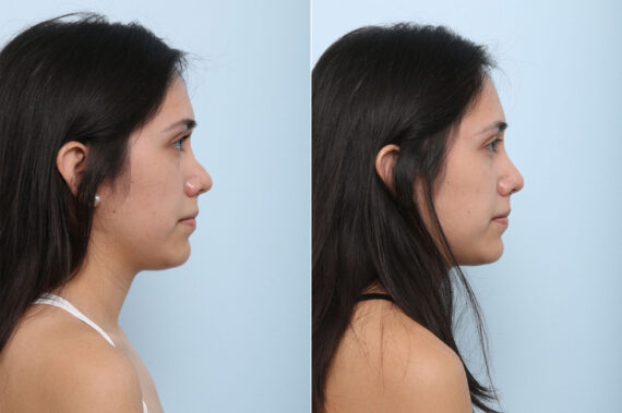 Non-Surgical Rhinoplasty before and after photos in Houston, TX, Patient 43157