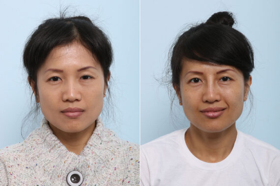 Non-Surgical Rhinoplasty before and after photos in Houston, TX, Patient 43164