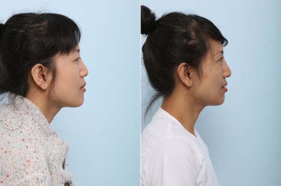 Non-Surgical Rhinoplasty before and after photos in Houston, TX, Patient 43164