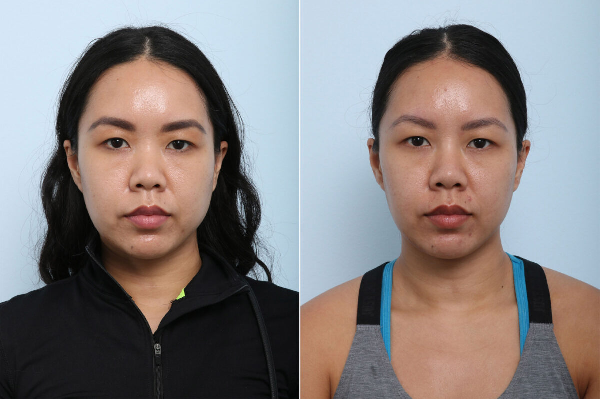 Non-Surgical Rhinoplasty before and after photos in Houston, TX, Patient 43171