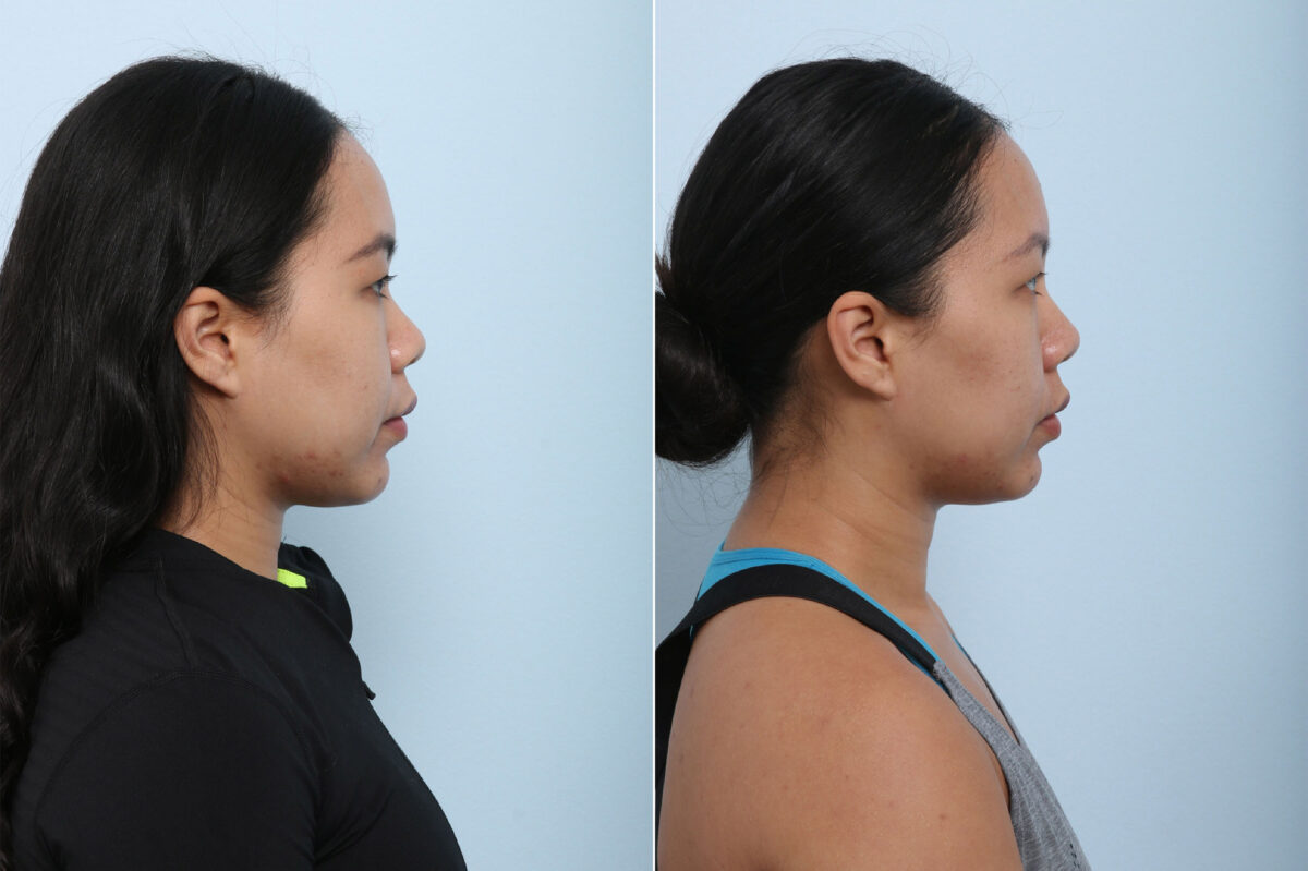 Non-Surgical Rhinoplasty before and after photos in Houston, TX, Patient 43171