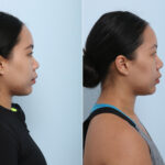 Non-Surgical Rhinoplasty before and after photos in Houston, TX, Patient 43171