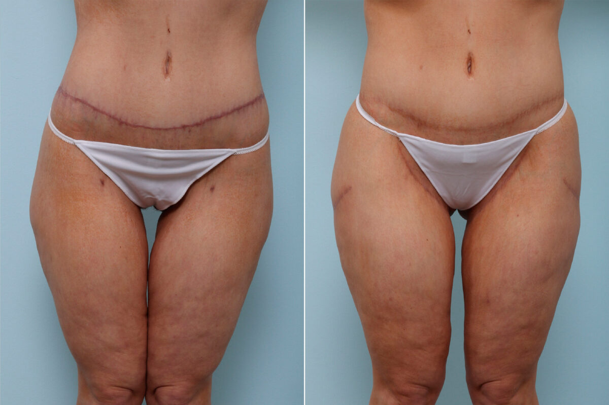 Thigh Lift before and after photos in Houston, TX, Patient 43208