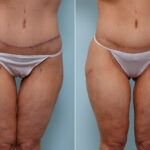 Thigh Lift before and after photos in Houston, TX, Patient 43208