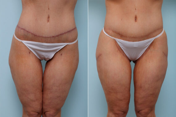 Thigh Lift before and after photos in Houston, TX, Patient 43208