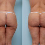 Thigh Lift before and after photos in Houston, TX, Patient 43208