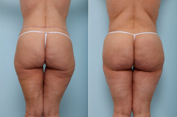 Thigh Lift before and after photos in Houston, TX, Patient 43208