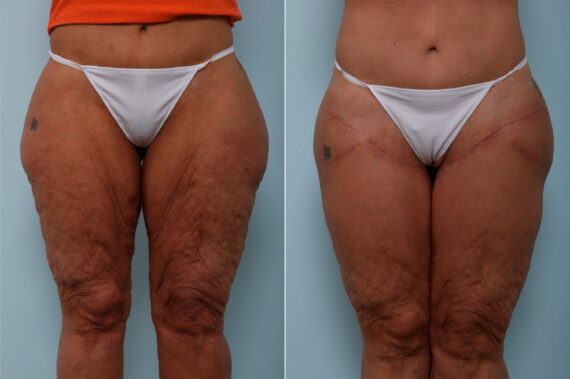 Thigh Lift before and after photos in Houston, TX, Patient 43215