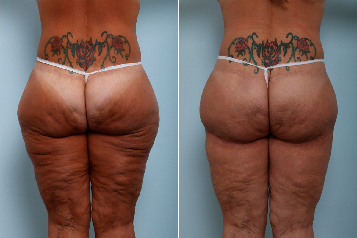Thigh Lift before and after photos in Houston, TX, Patient 43215