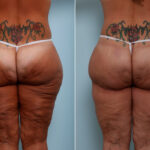 Thigh Lift before and after photos in Houston, TX, Patient 43215