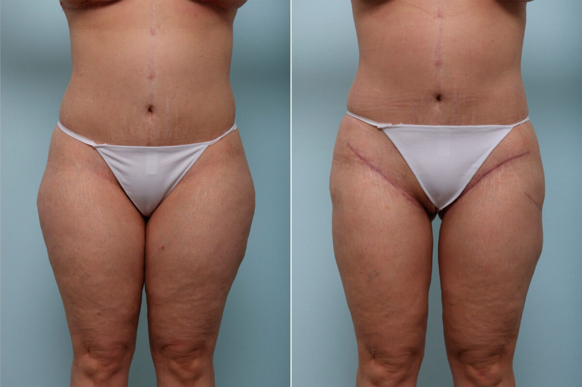 Thigh Lift before and after photos in Houston, TX, Patient 43222