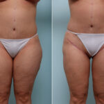 Thigh Lift before and after photos in Houston, TX, Patient 43222