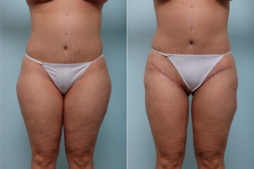 Thigh Lift before and after photos in Houston, TX, Patient 43222