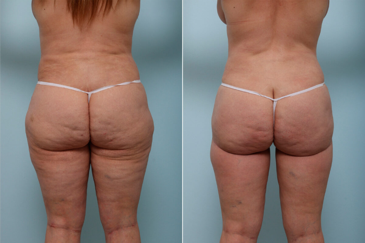 Thigh Lift before and after photos in Houston, TX, Patient 43222