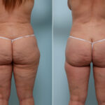 Thigh Lift before and after photos in Houston, TX, Patient 43222