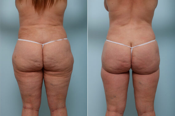 Thigh Lift before and after photos in Houston, TX, Patient 43222