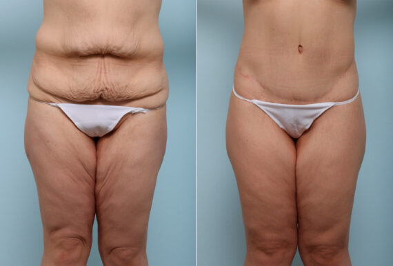 Body Lift before and after photos in Houston, TX, Patient 43529