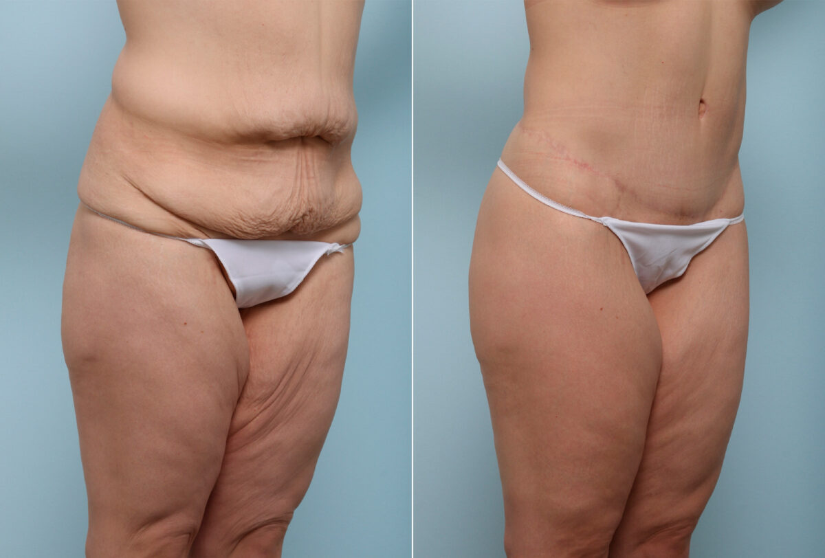 Body Lift before and after photos in Houston, TX, Patient 43529