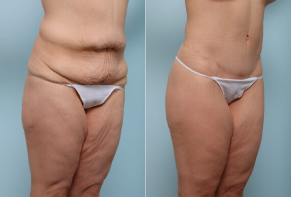 Body Lift before and after photos in Houston, TX, Patient 43529