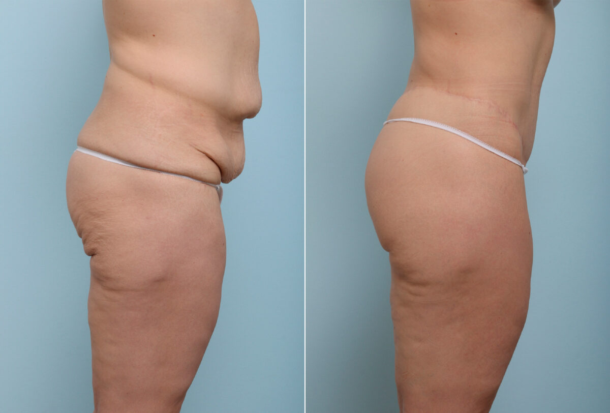 Body Lift before and after photos in Houston, TX, Patient 43529