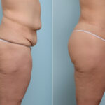 Body Lift before and after photos in Houston, TX, Patient 43529