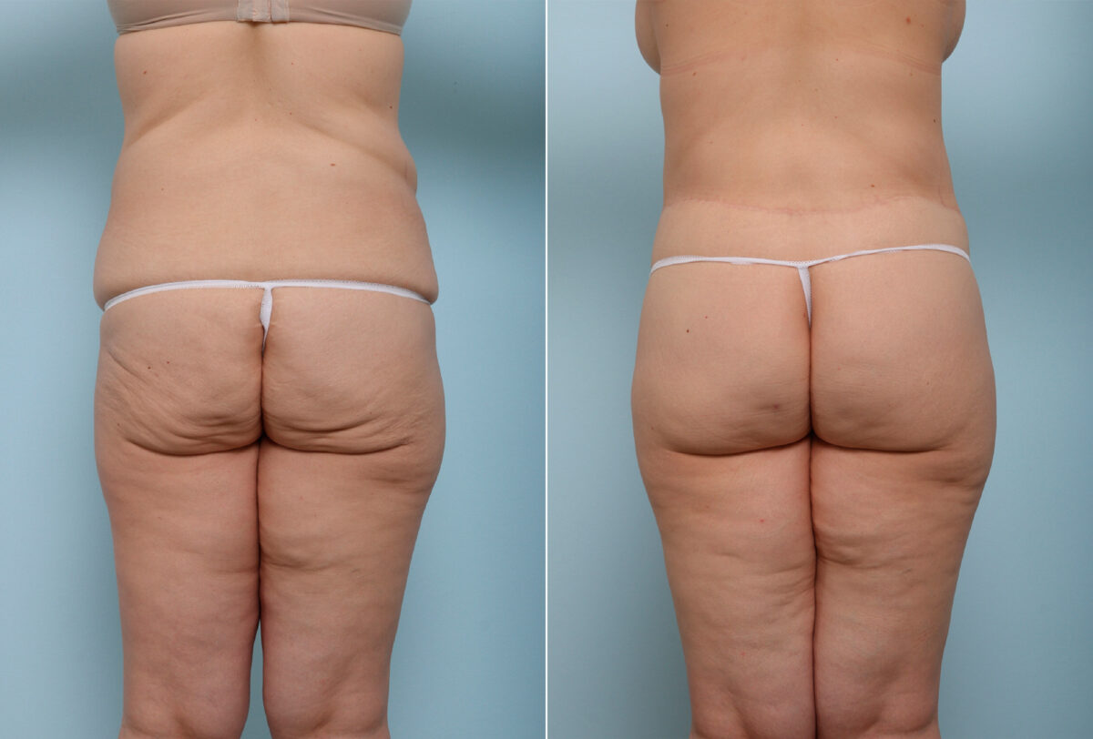 Body Lift before and after photos in Houston, TX, Patient 43529