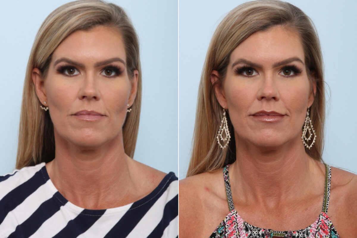 Juvederm Injectable Gel before and after photos in Houston, TX, Patient 43545