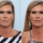 Juvederm Injectable Gel before and after photos in Houston, TX, Patient 43545