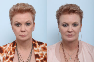 Lip Shortening Surgery before and after photos in Houston, TX, Patient 44022