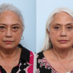Lip Shortening Surgery before and after photos in Houston, TX, Patient 44024