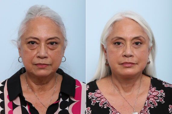 Lip Shortening Surgery before and after photos in Houston, TX, Patient 44024