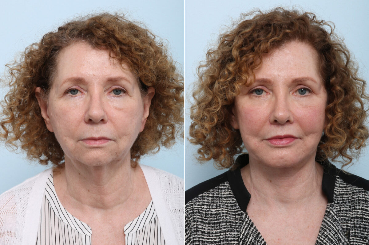 Lip Shortening Surgery before and after photos in Houston, TX, Patient 44029